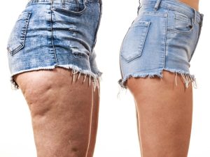 combattre la cellulite